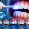 Laser Teeth Whitening: Is It Safe? Everything You Need to Know in 2026